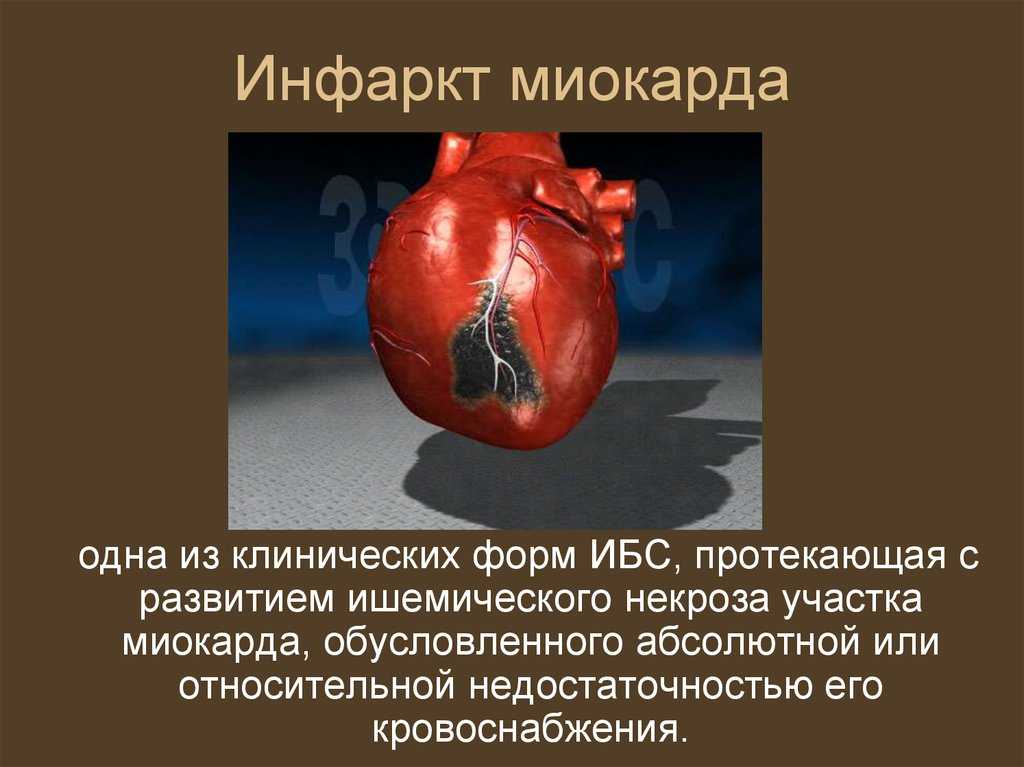 Гемофилия цинга инфаркт миокарда. Обширный инфаркт Миокарт. Обширный инфаркт сердца. Инфаркт миокарда сердце.